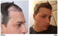 ForHair Hair Transplant Clinic image 7